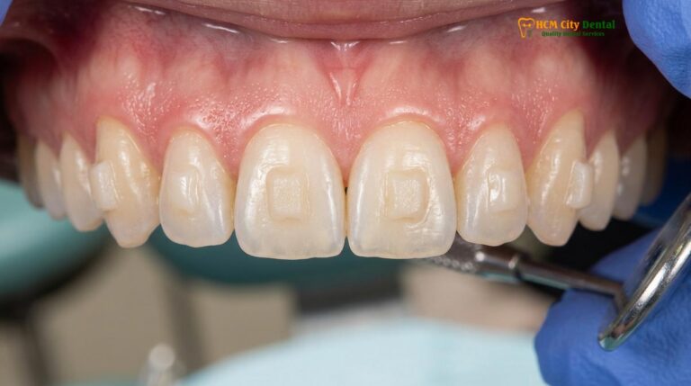 Invisalign Attachments & Buttons: Why They Are Needed | HCMC Dental