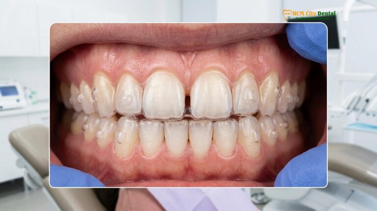 Invisalign for Crowding and Gaps: Clinical Guide | HCMC Dental