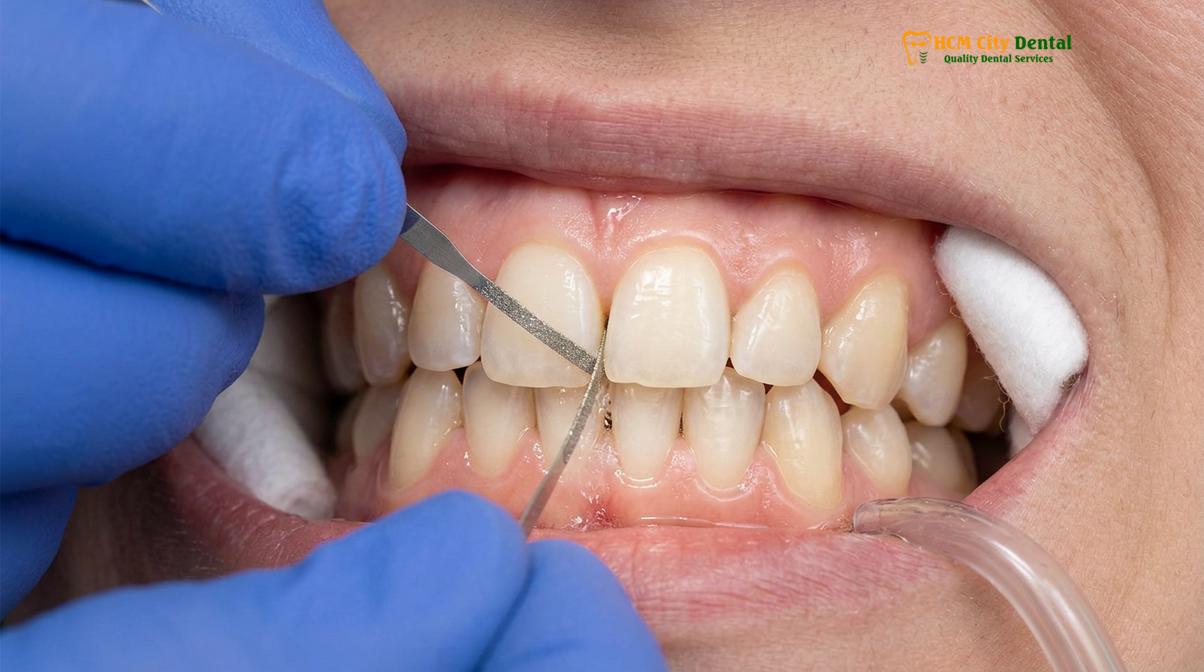 Visual description of Invisalign for Crowding and Gaps