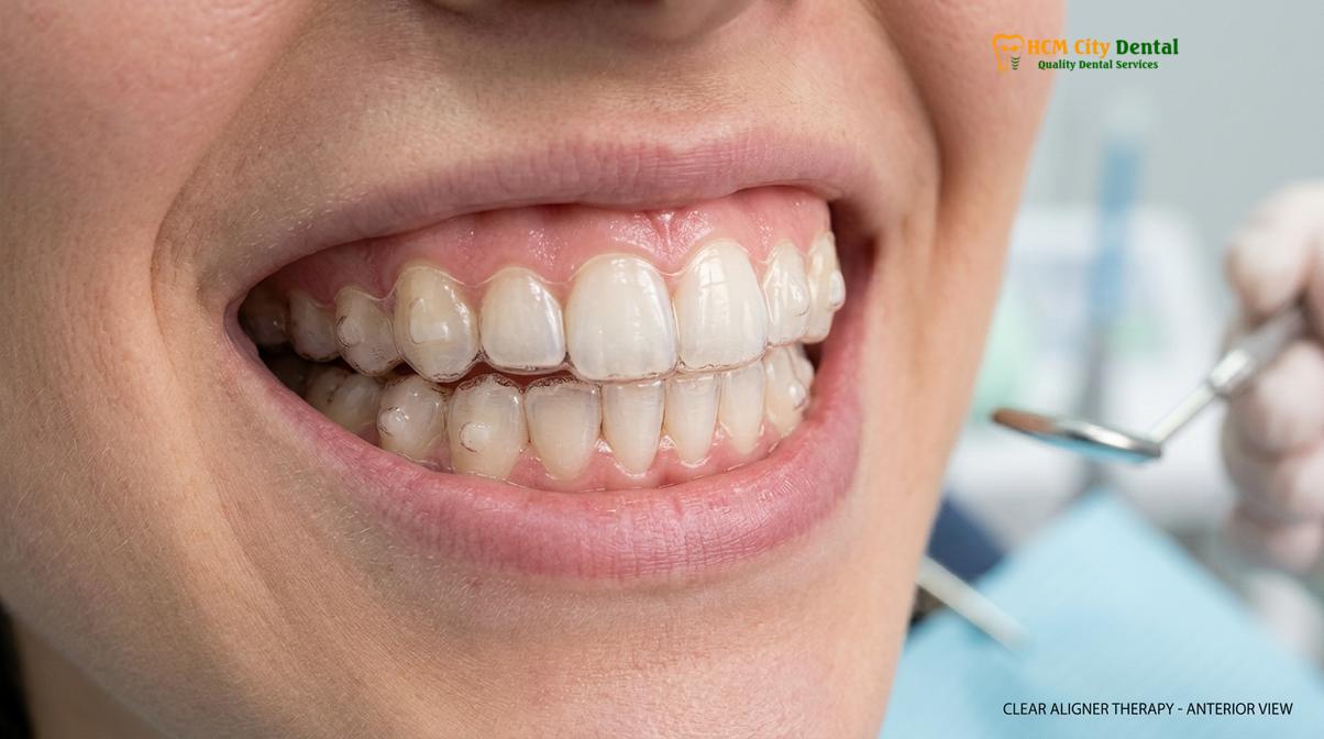 Clinical photography related to Invisalign Go vs Lite vs Comprehensive
