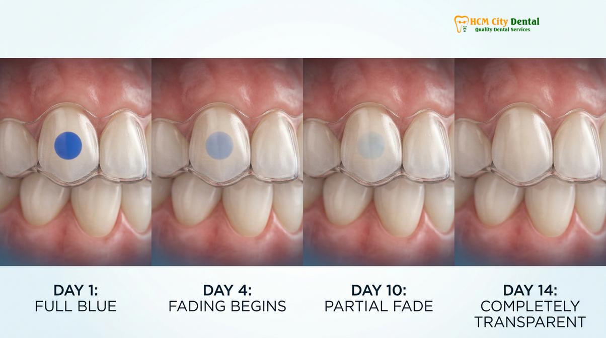 Clinical photography related to Invisalign Teen Compliance Indicators Saigon