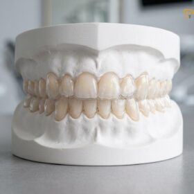 Invisalign Vivera Retainers Cost & Clinical Guide | HCMC Dental