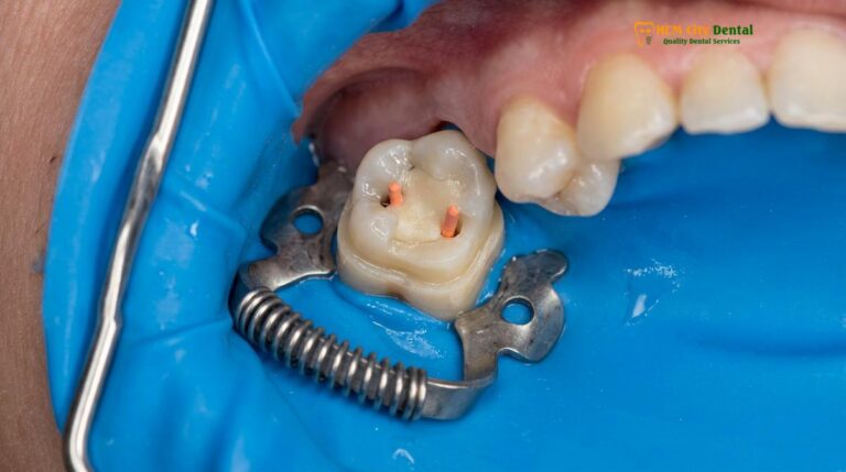 Is a Crown After Root Canal Necessary? Clinical Guidelines & Options