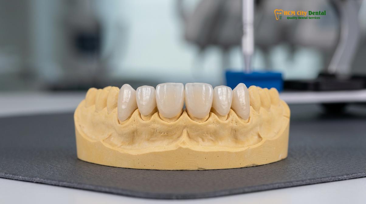 Visual description of digital scan veneers vietnam