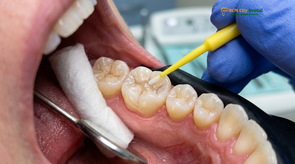 Visual description of kids dental cleaning fissure sealants