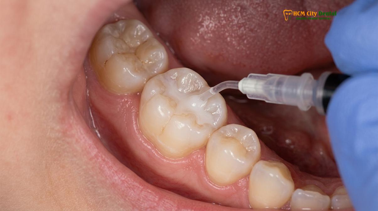 Clinical photography related to kids dentist phu my hung