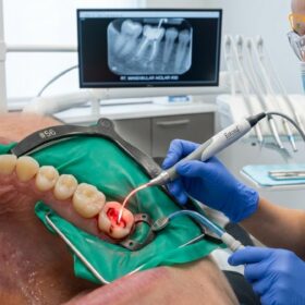 Laser Root Canal Disinfection: Clinical Guide | HCMC Dental