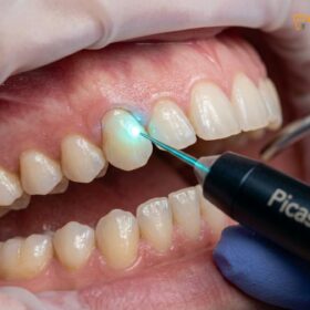Laser Gingivectomy Cost Vietnam: Clinical Pricing & Workflows