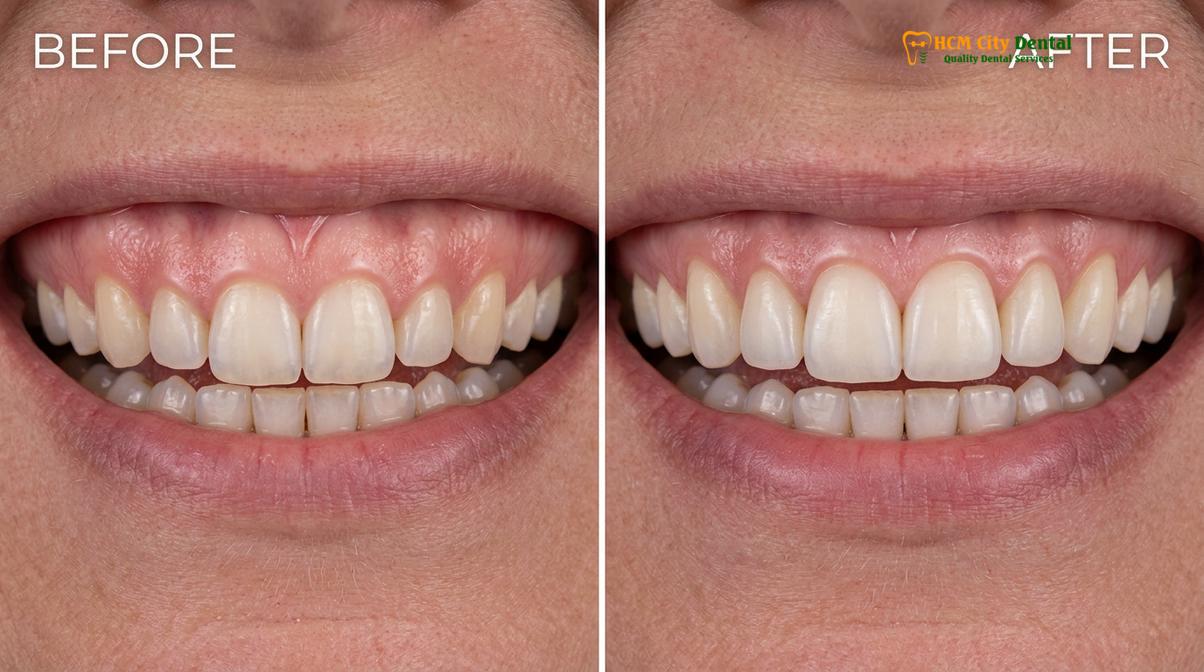 Visual description of Laser Gingivectomy Cost Vietnam