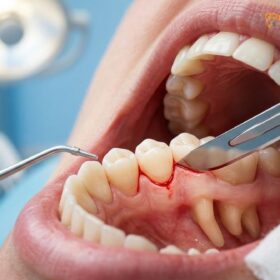 Laser vs Scalpel Gingivectomy: Clinical Comparison & Recovery