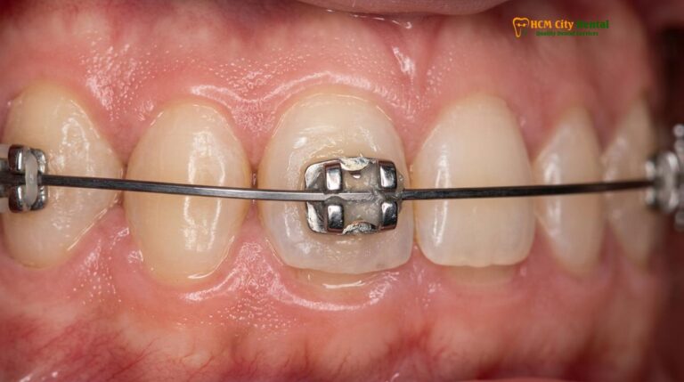 Loose Braces Bracket Emergency Repair | HCMC Dental