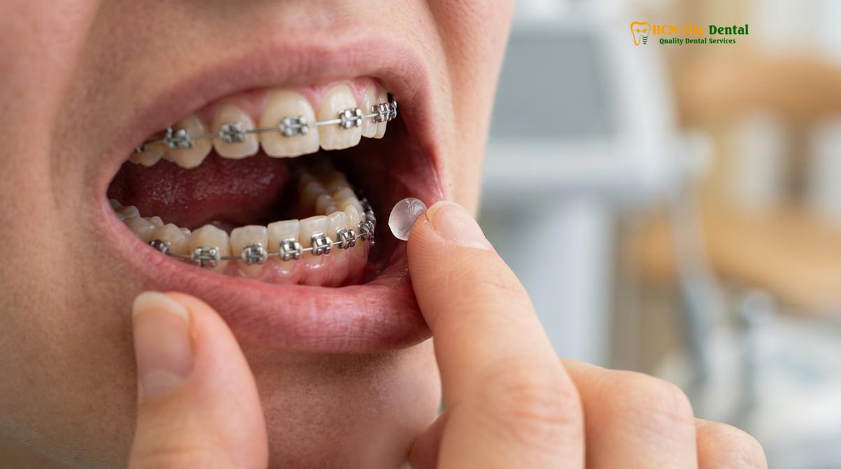 Visual description of Loose Braces Bracket Emergency Repair