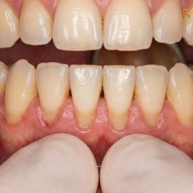 Loose Tooth Adult Emergency: Causes & Care | HCMC Dental