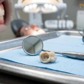 Lost Crown or Filling in Vietnam: Emergency Clinical Guide | HCMC Dental