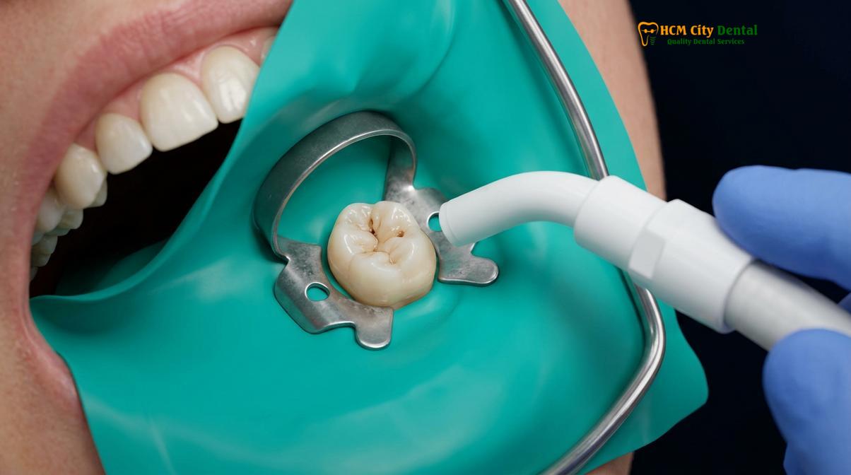 Clinical photography related to mercury safe dentist
