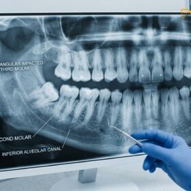 Mesioangular Wisdom Tooth: Clinical Guide | HCMC Dental