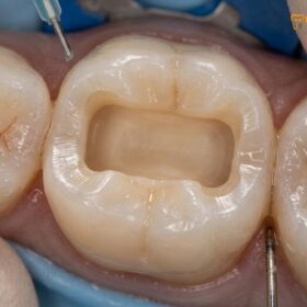 Metal Free Onlays Benefits: Clinical Guide to Biocompatible Restorations