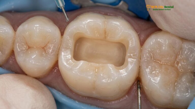 Metal Free Onlays Benefits: Clinical Guide to Biocompatible Restorations