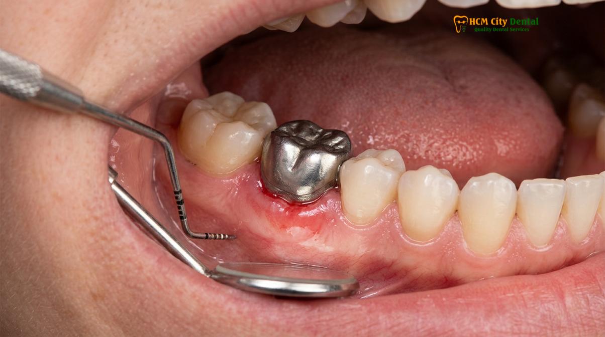 Clinical photography related to titanium allergy dental implants