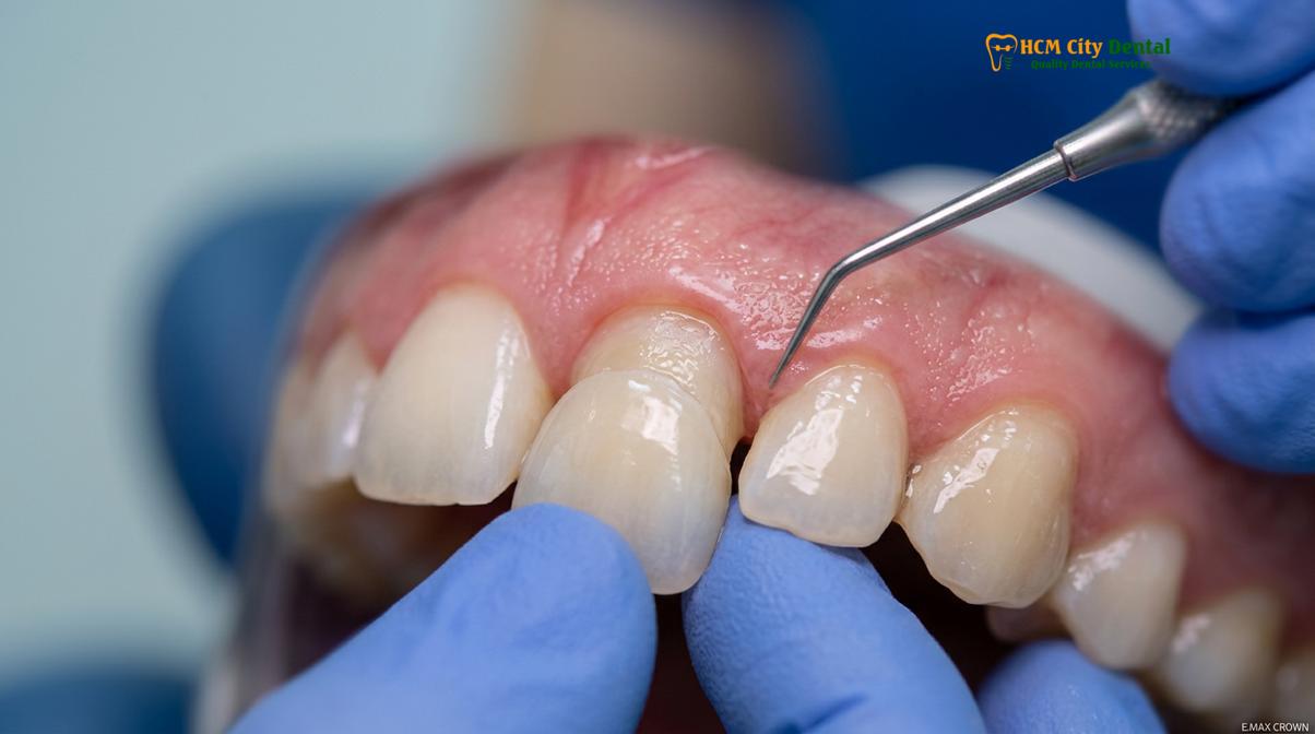 Visual description of monolithic zirconia vs layered crowns