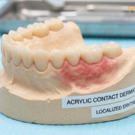 Hypoallergenic Dentures Saigon: Monomer-Free Options | HCMC Dental