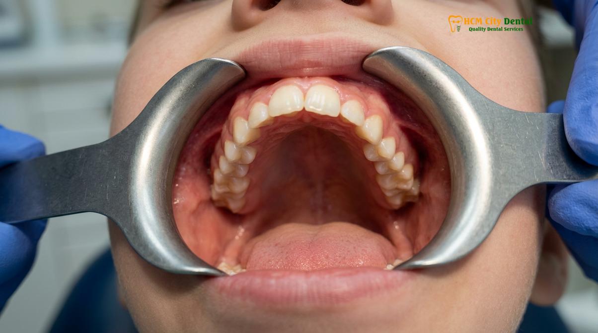 Visual description of mouth breathing kids face shape
