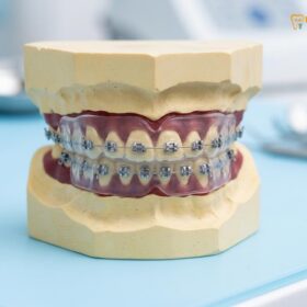 Mouthguard with Braces Orthodontics: Clinical Guide | HCMC Dental