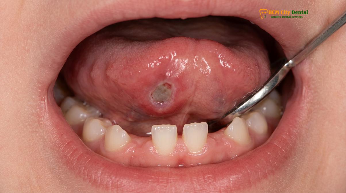 Clinical photography related to natal teeth