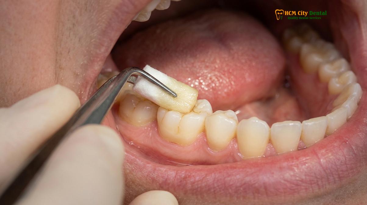 Clinical photography related to natural toothache remedies