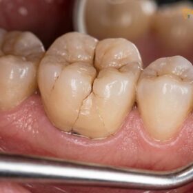 Night Guard After Dental Crowns: Clinical Guide | HCMC Dental