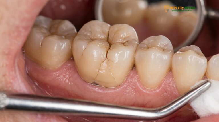 Night Guard After Dental Crowns: Clinical Guide | HCMC Dental