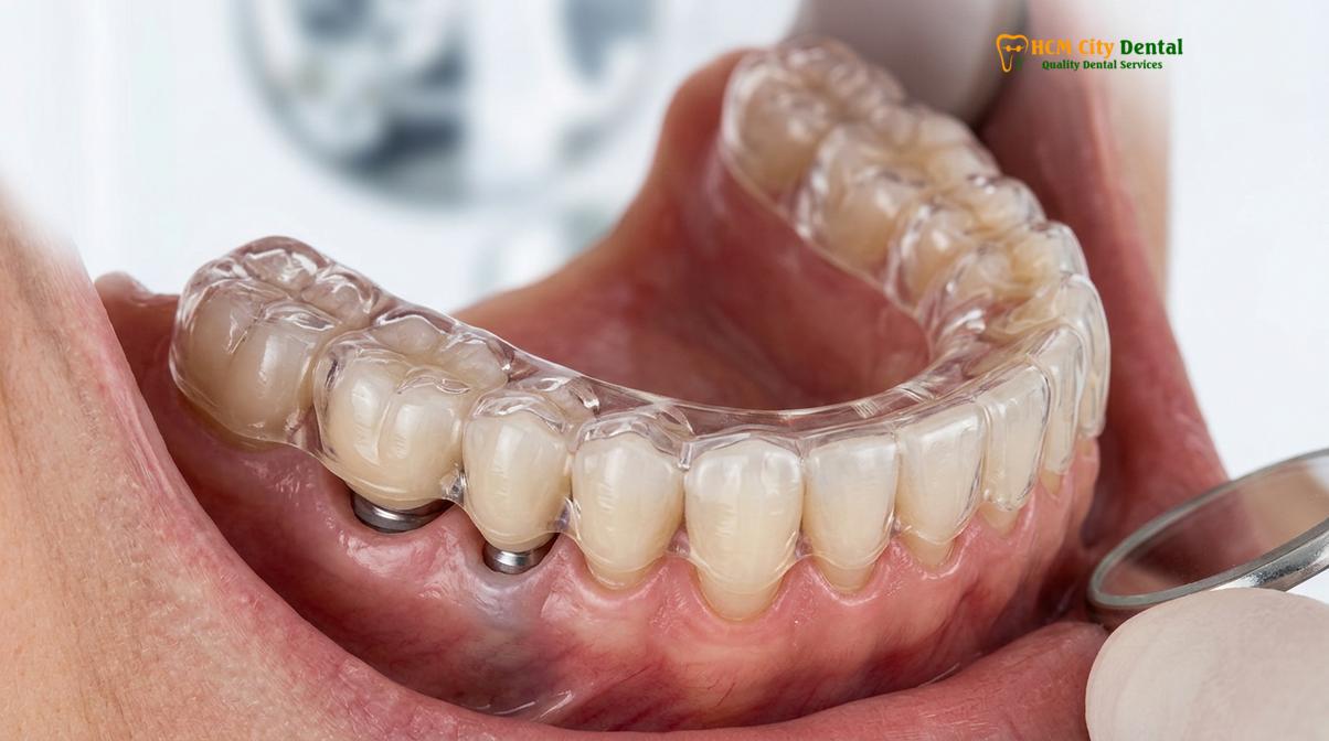 Visual description of night guard for dental implants