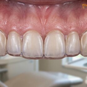 Night Guard for Veneers Protection: Clinical Guide | HCMC Dental