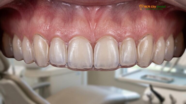 Night Guard for Veneers Protection: Clinical Guide | HCMC Dental