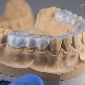 Night Guard Not Fitting Properly: Clinical Causes & Fixes | HCMC Dental
