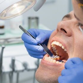 Bite Adjustment for TMJ Vietnam: Clinical Guide | HCMC Dental