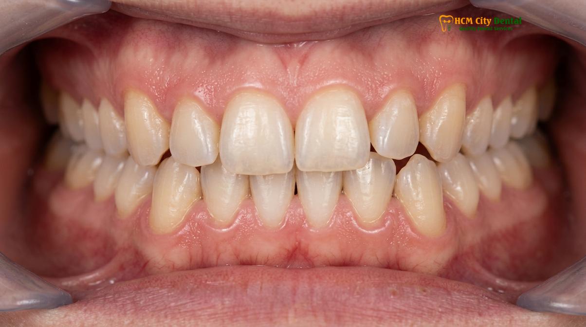 Clinical photography related to Orthodontic Relapse Why Teeth Move After Braces