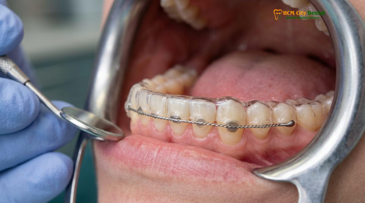 Visual description of Orthodontic Relapse Why Teeth Move After Braces