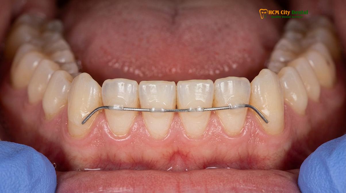 Visual description of orthodontic retainer price Ho Chi Minh City