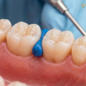 Orthodontic Spacers Separators Pain: Clinical Guide | HCMC Dental