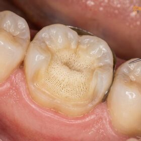 Sensitivity After Inlay Onlay Placement: Clinical Guide & Timeline