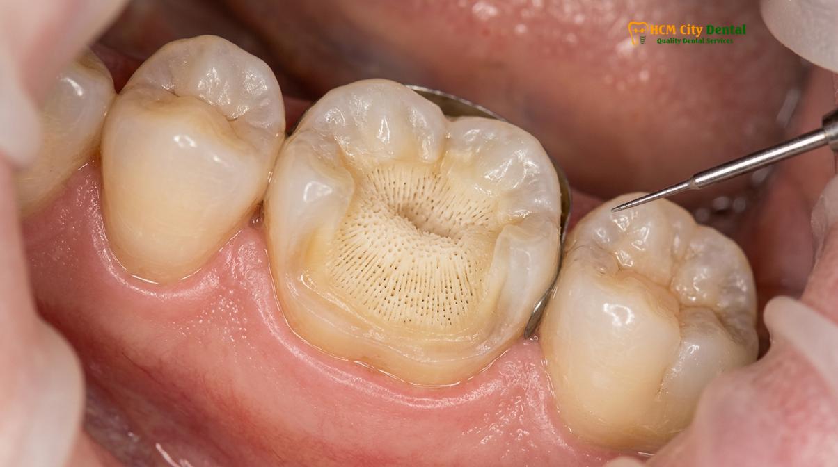 Clinical illustration of sensitivity after inlay onlay placement