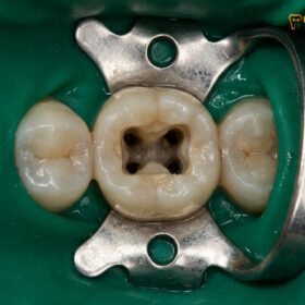 Pain After Root Canal: Normal vs Emergency | HCMC Dental
