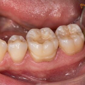 Partial Crown vs Full Crown: Clinical Comparison & Material Guide