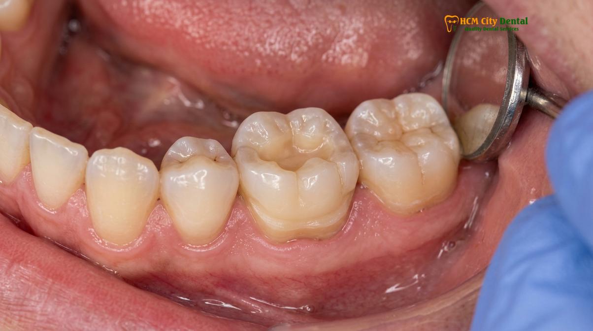 Clinical illustration of partial crown vs full crown