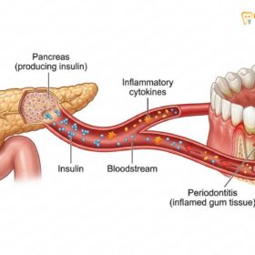 Periodontal Disease & Diabetes: Clinical Link | HCMC Dental