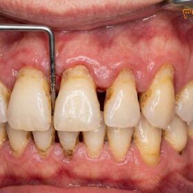 Full Mouth Reconstruction for Gum Disease: Clinical Protocols