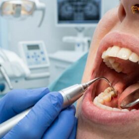 Scaling and Root Planing Cost in Vietnam: Clinical Guide & Pricing