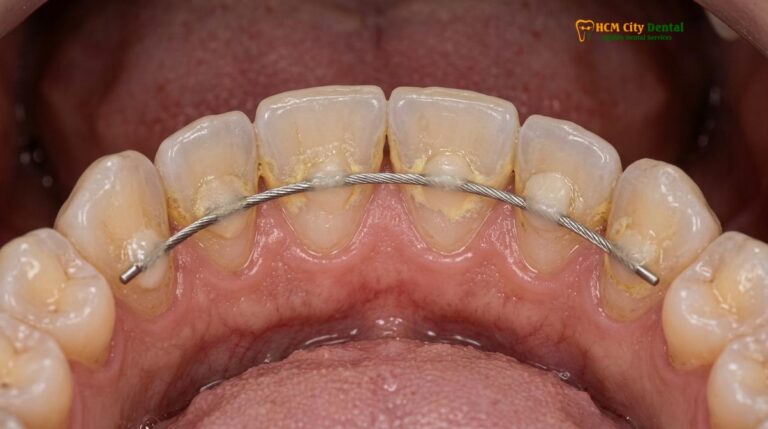 Permanent Retainer Plaque Removal: Clinical Guide | HCMC Dental