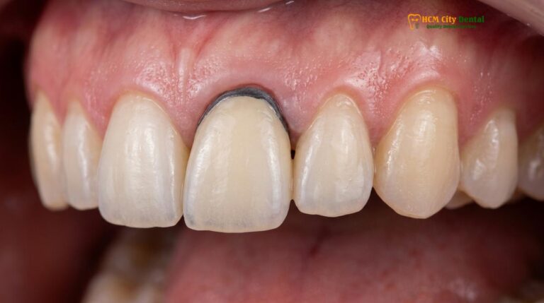 PFM Crowns Dark Line at Gumline: Causes & Clinical Solutions
